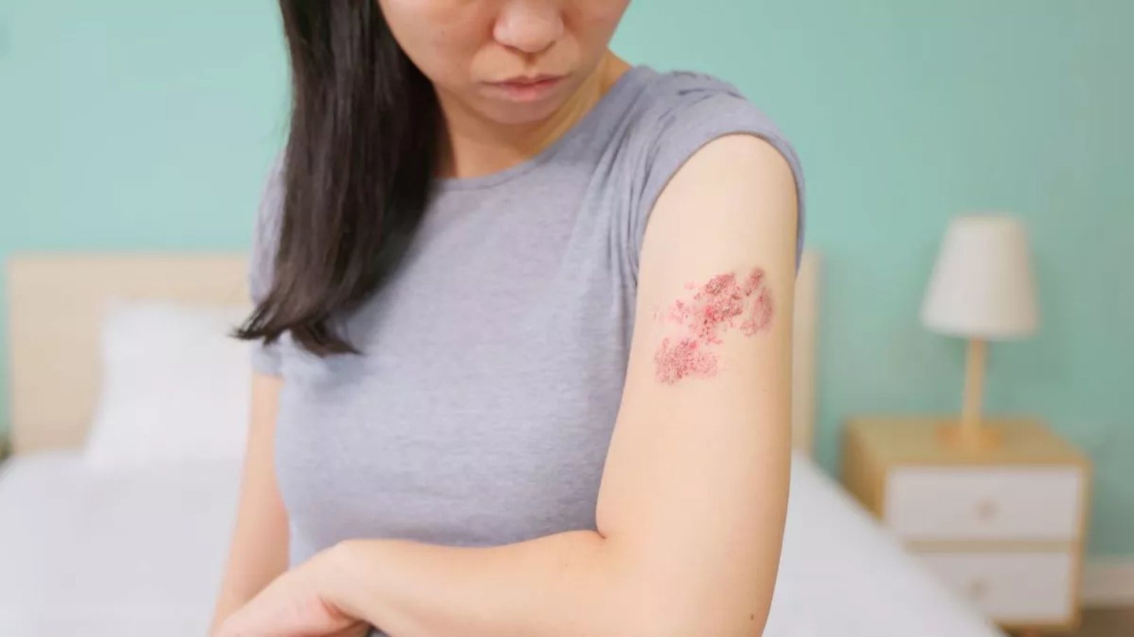 โรคงูสวัด (Herpes Zoster)